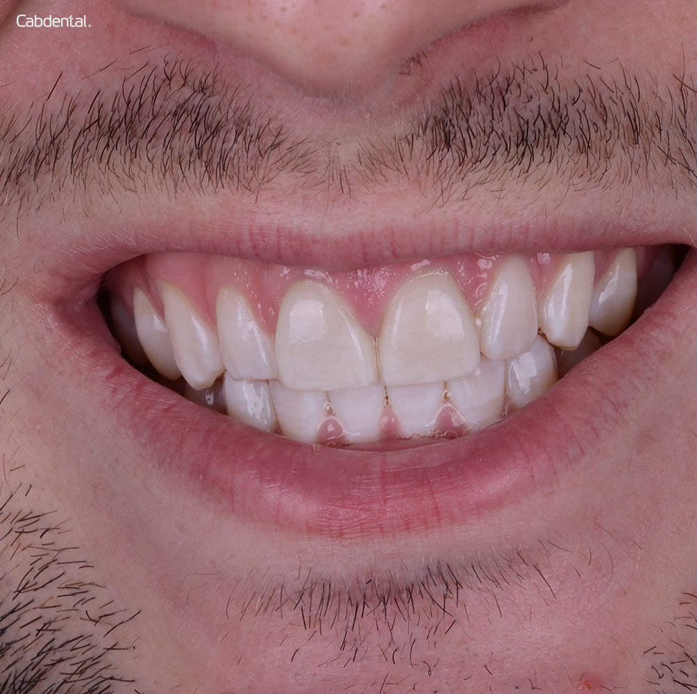 Carillas dentales antes y después