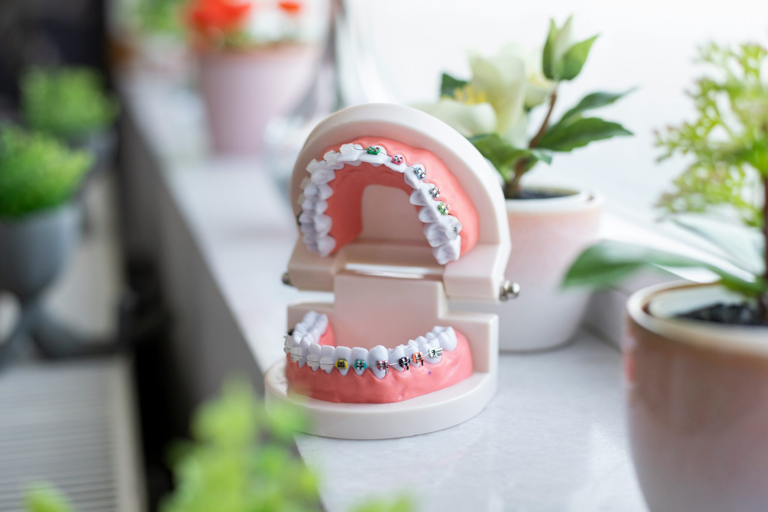 3 Modelos de Brackets Dentales en Guadalajara